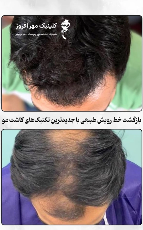 خط رویش طبیعی در کاشت مو