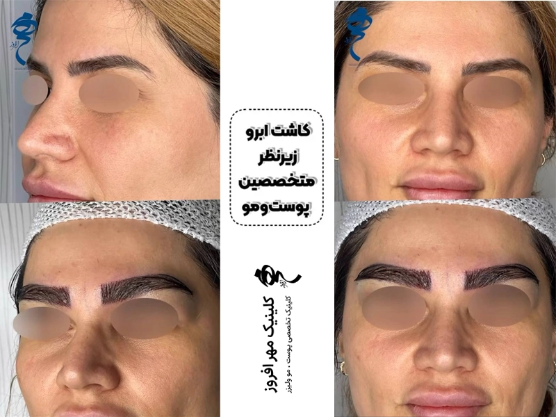 کاشت ابرو طبیعی