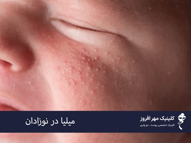 میلیا در نوزادان