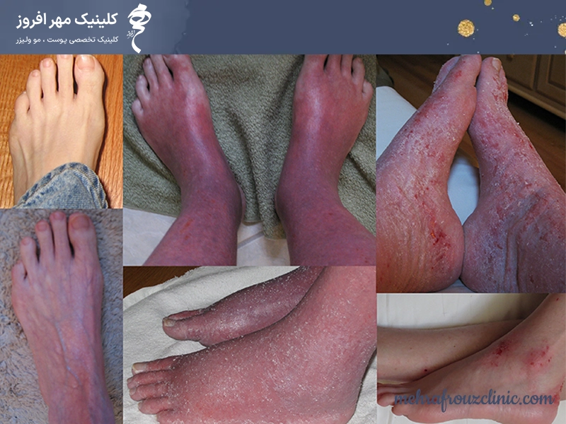 مشکلات پوستی سندروم DRESS