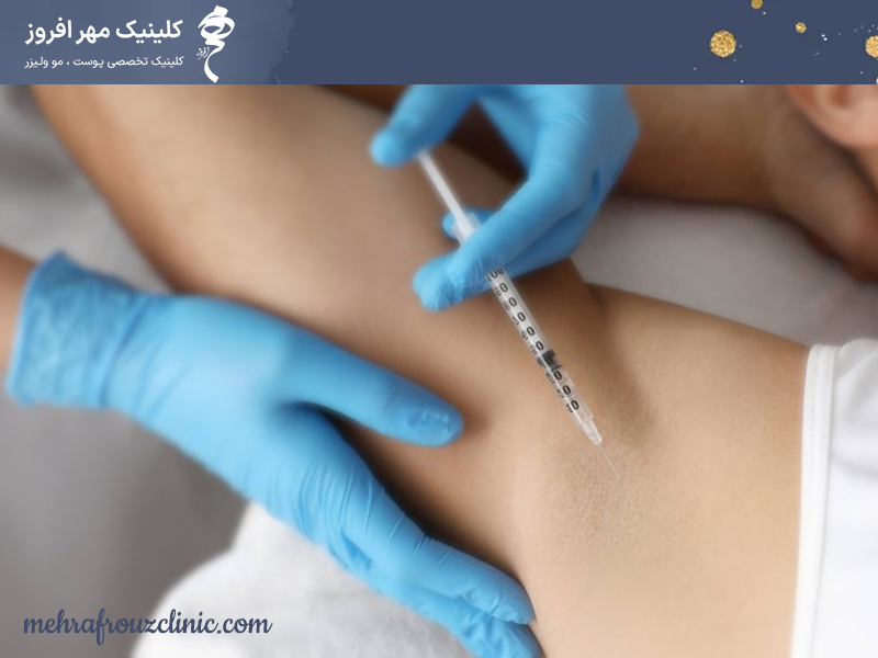 بوتاکس زیربغل برای تعرق