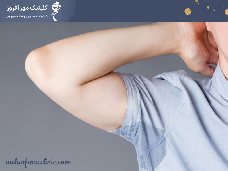 درمان تعریق با بوتاکس