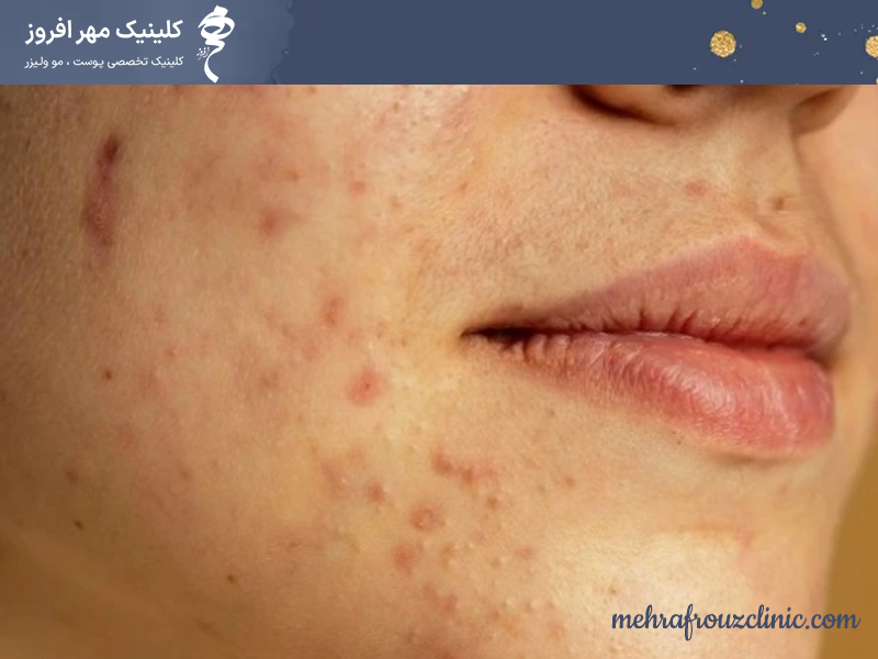 جوش های استرسی و عصبی