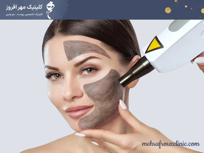 لایه برداری با پیلینگ کربن