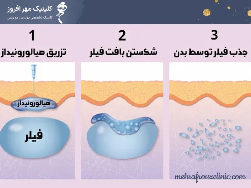 هیالورونیداز