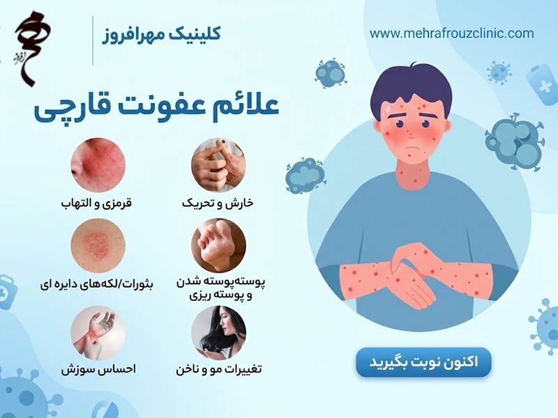 علائم قارچ پوستی