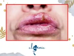 رفع عوارض ژل
