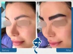 قیمت کاشت ابرو