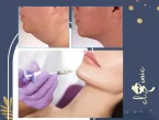 نحوه تزریق ژل به چانه