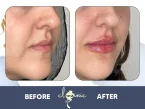 ژل لب یا تکنیک اگولیپس