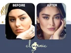 کاشت ابرو سحر قریشی