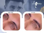 کاشت ابرو مردانه